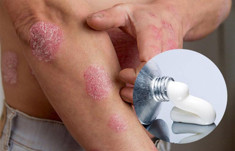 Khám phá 7 công dụng và lưu ý khi sử dụng Terbiskin