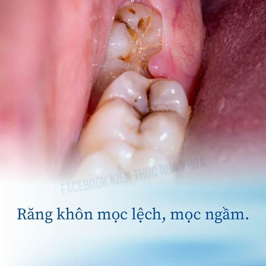 Khám phá 7 địa chỉ nha khoa uy tín tại Buôn Ma Thuột chuyên nhổ răng khôn, mang đến sự chăm sóc chu đáo và chất lượng cao