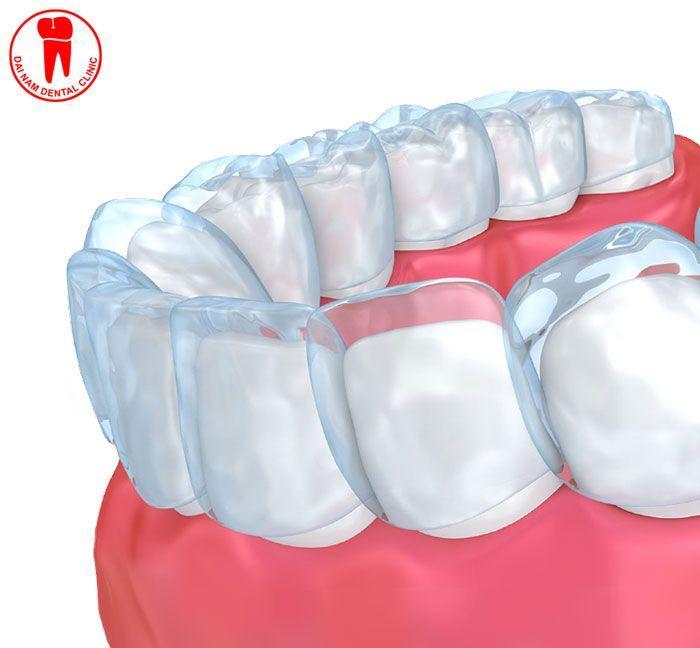 7 Địa chỉ niềng răng Invisalign uy tín tại TP. Thủ Đức