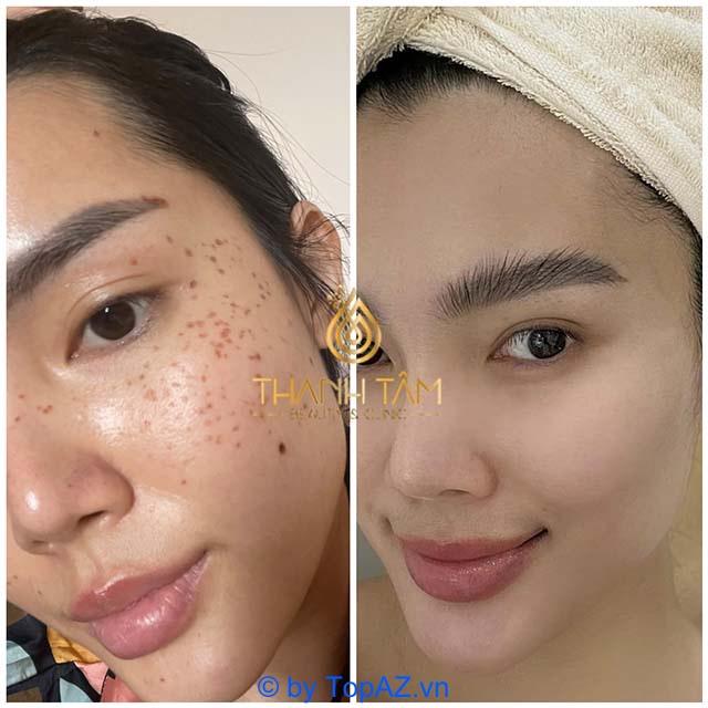 5 Địa chỉ Spa trị nám và tàn nhang tại Quận 9 đáng trải nghiệm nhất