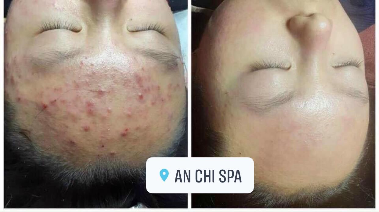 7 Địa chỉ Spa trị mụn uy tín nhất Nhơn Trạch, Đồng Nai – Lựa chọn hoàn hảo cho làn da sạch mụn