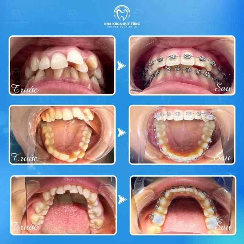 Top 10 địa chỉ niềng răng đáng tin cậy nhất tại Thái Nguyên
