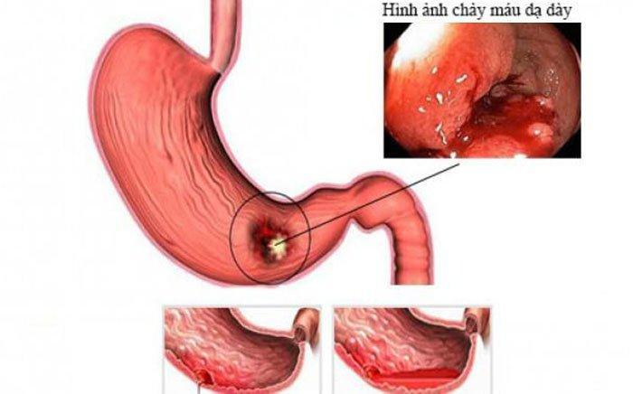 7 Bệnh lý dạ dày phổ biến bạn nên biết để phòng ngừa hiệu quả