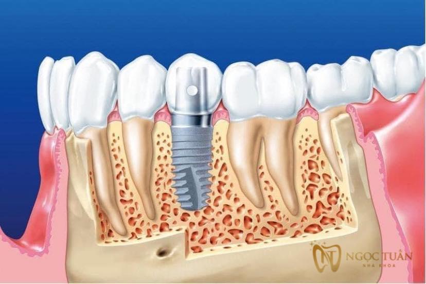 Top 5 Nha khoa uy tín tại Thái Bình chuyên về trồng răng Implant