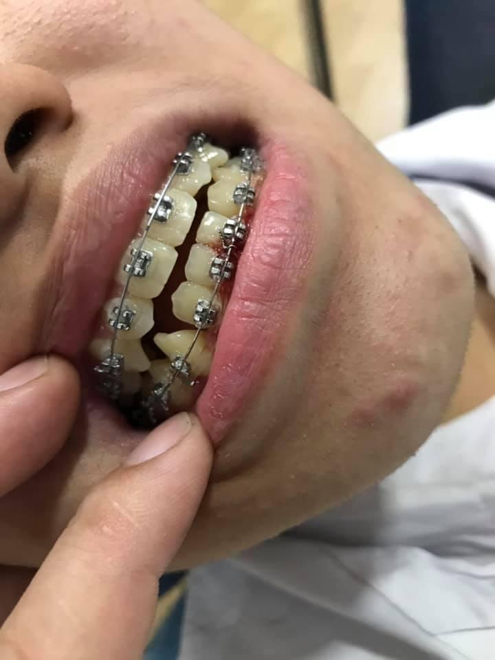Top 4 Địa chỉ niềng răng uy tín và đẹp nhất tại Kon Tum
