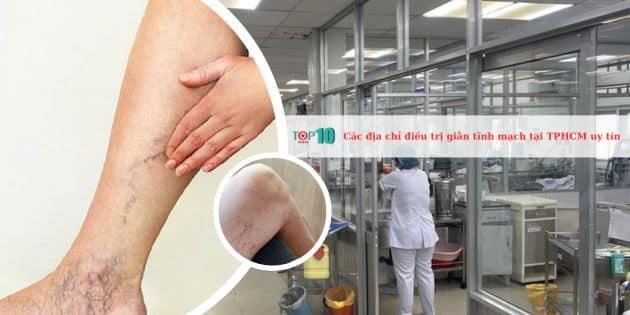 Top 10 địa chỉ uy tín và hiệu quả trong điều trị giãn tĩnh mạch tại TPHCM