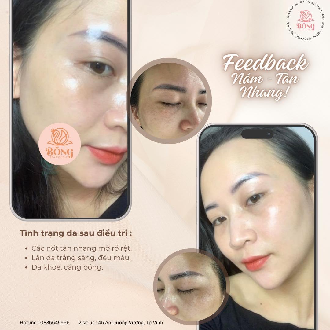 Top 8 địa chỉ trị nám, tàn nhang, đồi mồi uy tín và hiệu quả nhất tại TP. Vinh, Nghệ An