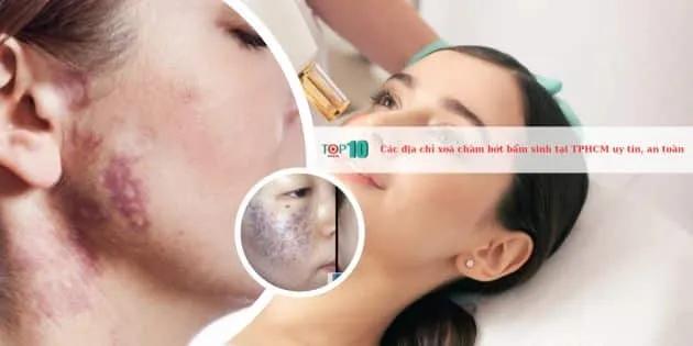 7 địa chỉ xóa chàm bớt bẩm sinh hàng đầu tại TP.HCM: Uy tín và an toàn tuyệt đối