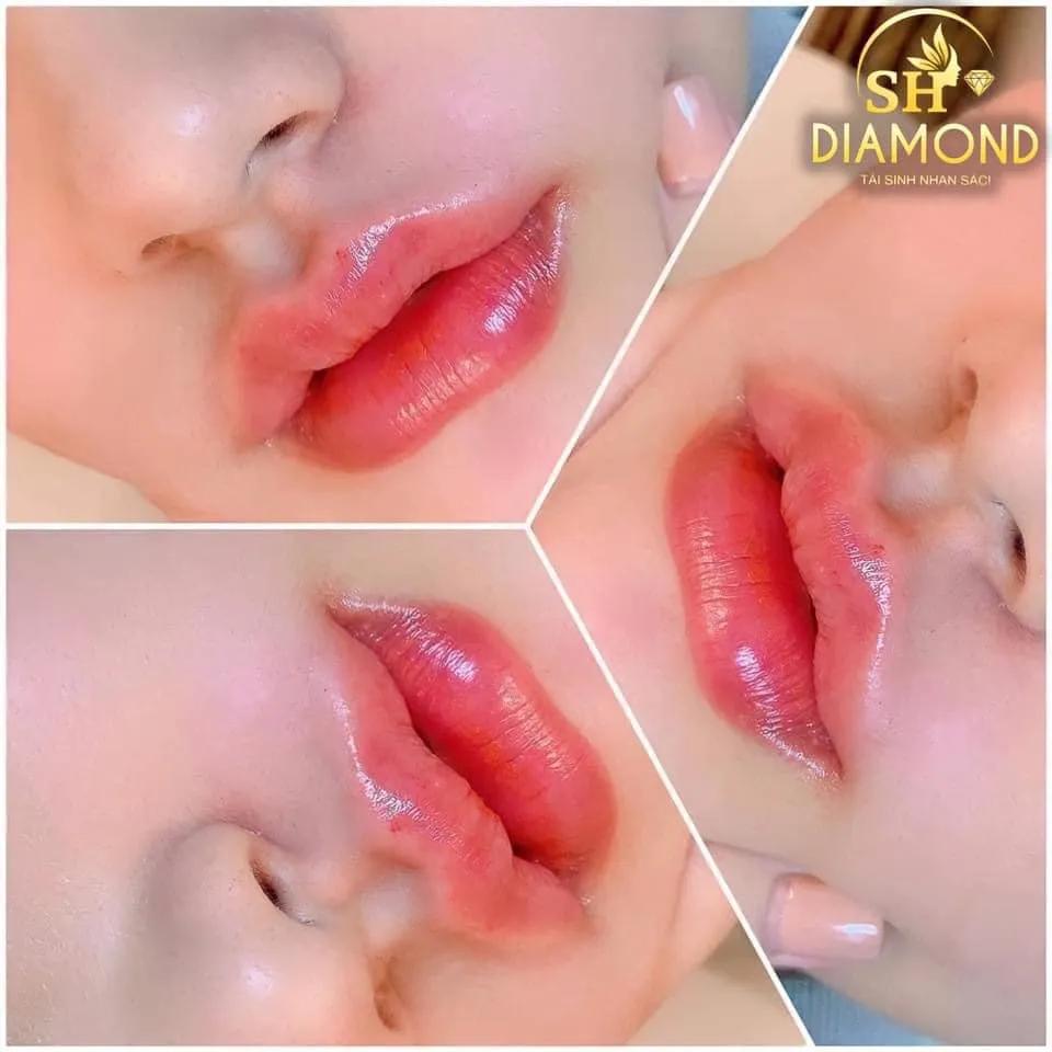 Top 5 địa chỉ tiêm filler - botox chất lượng và uy tín bậc nhất tại thành phố Huế