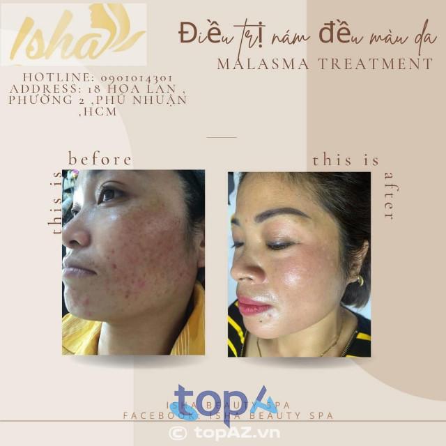 Top 5 spa điều trị nám và tàn nhang hiệu quả tại quận Phú Nhuận