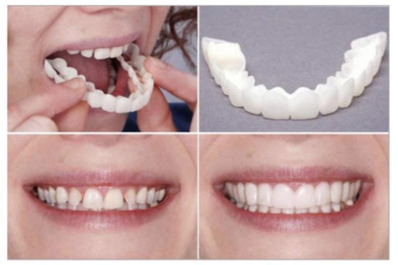 8 Điều Cốt Lõi Cần Biết Về Răng Giả Tháo Lắp