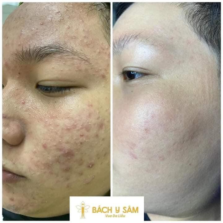 Top 5 spa điều trị mụn hiệu quả tại thị xã Hồng Lĩnh, Hà Tĩnh