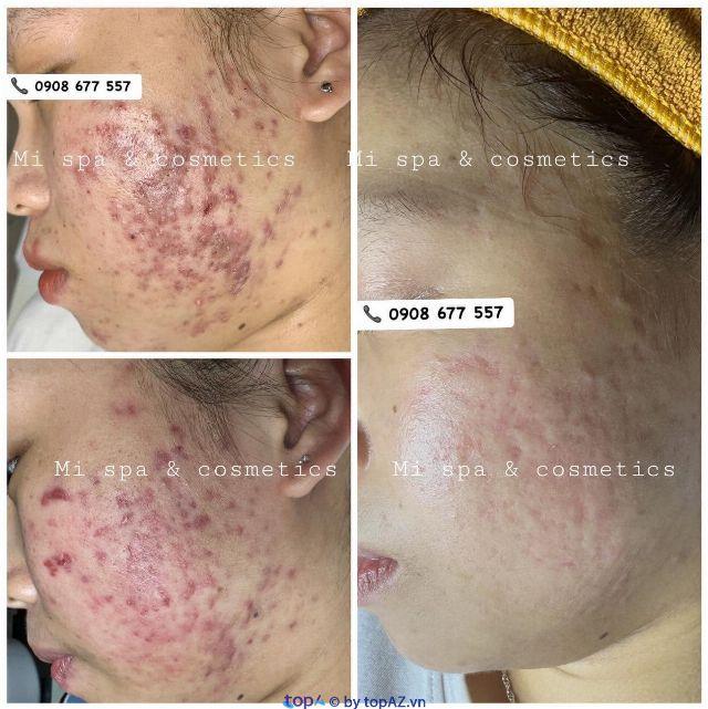 Top 5 Spa trị mụn và làm đẹp uy tín tại TP Thuận An