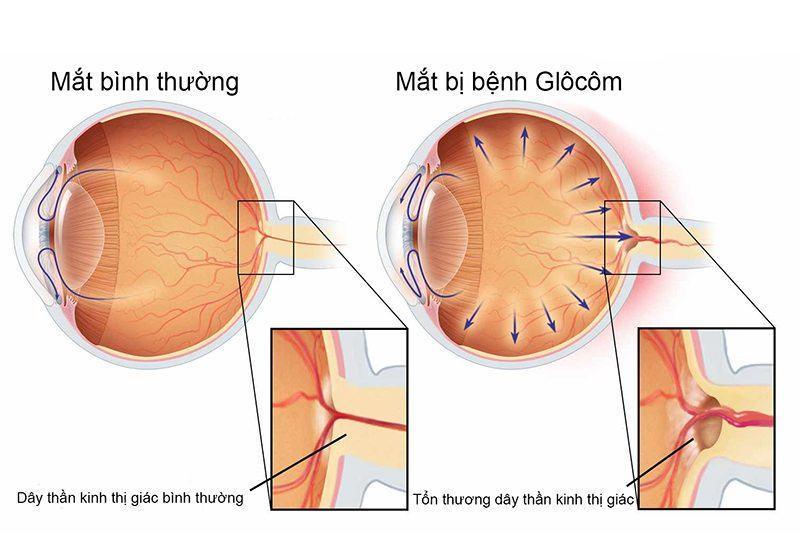 11 Nguyên Nhân Phổ Biến Dẫn Đến Bệnh Tăng Nhãn Áp