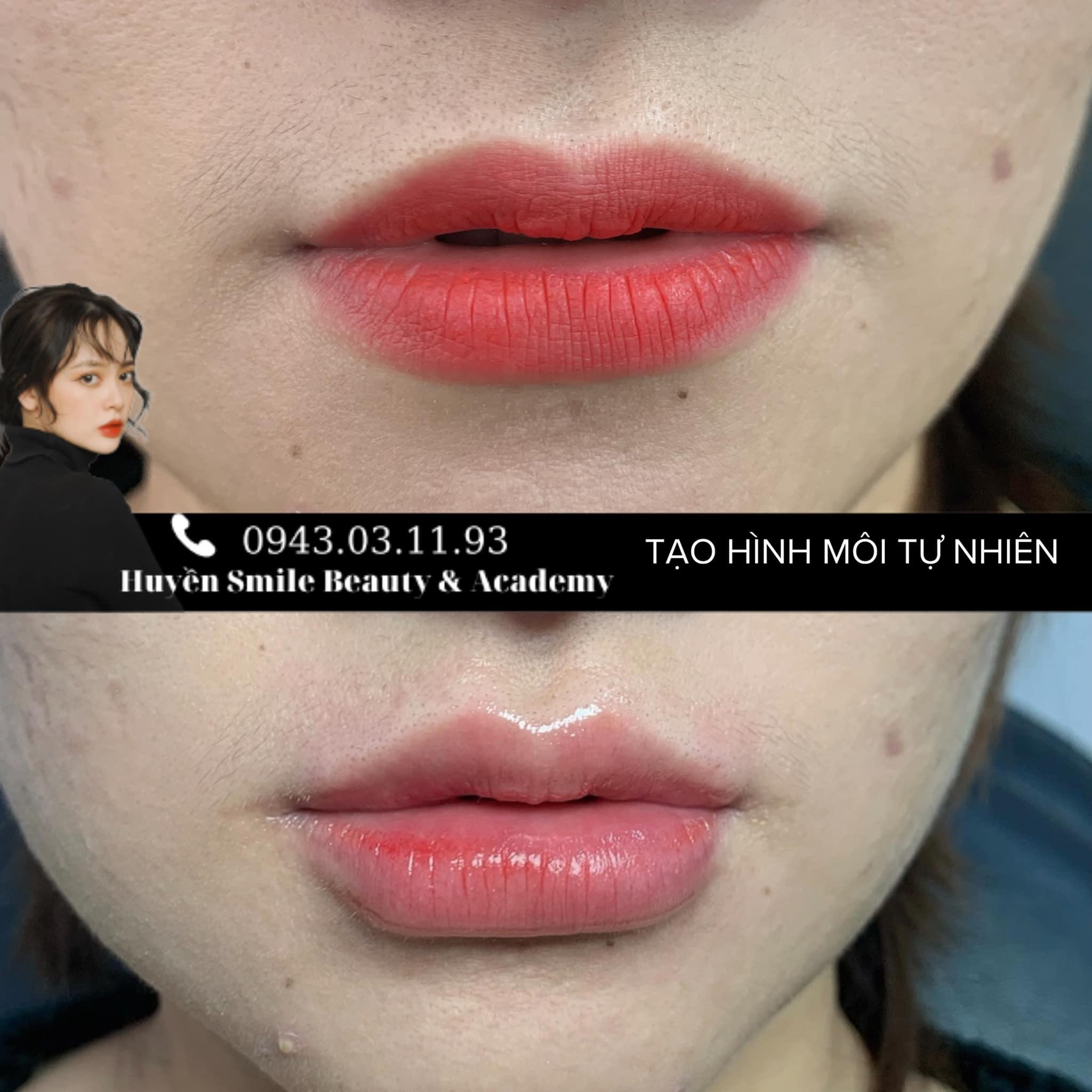 Top 8 địa chỉ tiêm filler - botox uy tín, chất lượng tại TP. Buôn Ma Thuột không thể bỏ qua