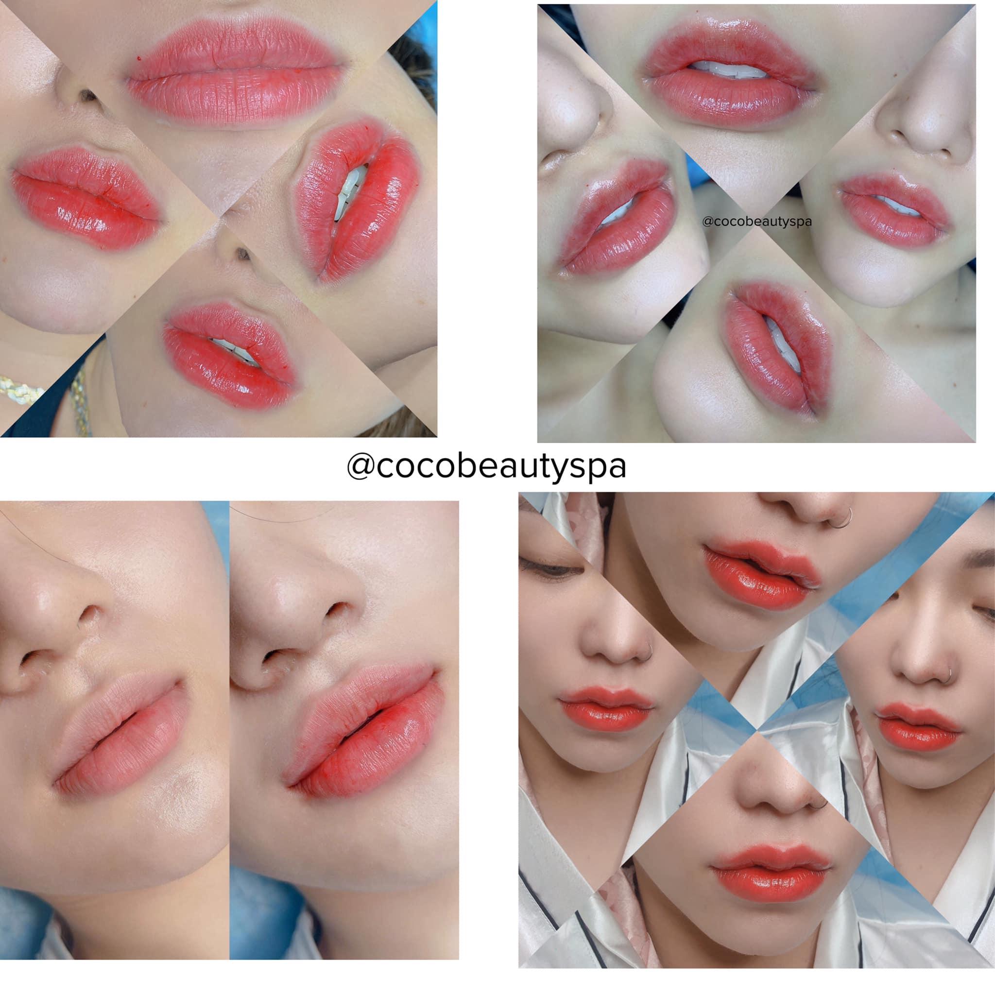 Top 7 Địa Chỉ Tiêm Filler - Botox Uy Tín Và Chất Lượng Hàng Đầu Tại Rạch Giá, Kiên Giang