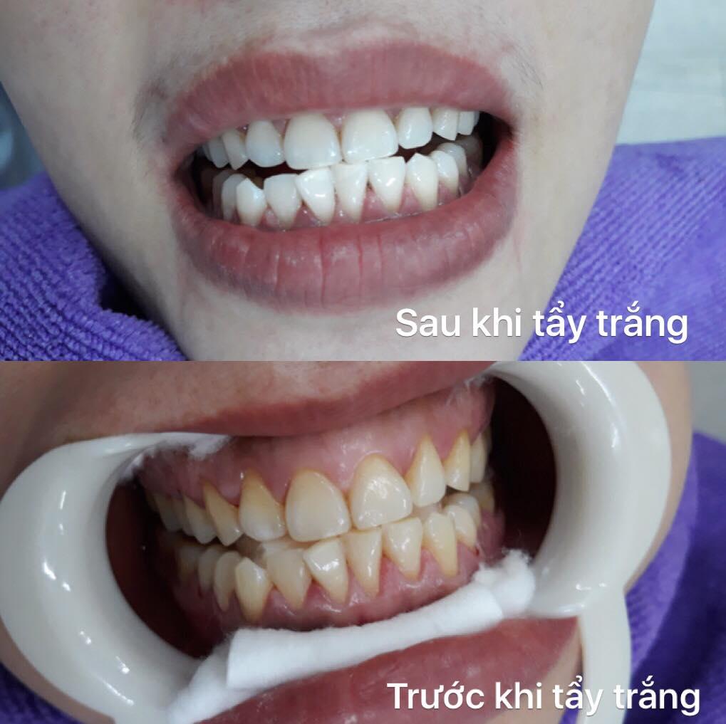 4 Địa điểm tẩy trắng răng đáng tin cậy nhất tại Nam Định