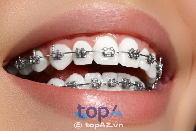 Top 5 địa chỉ niềng răng uy tín tại Nha Trang - Chất lượng đảm bảo, giá cả phải chăng