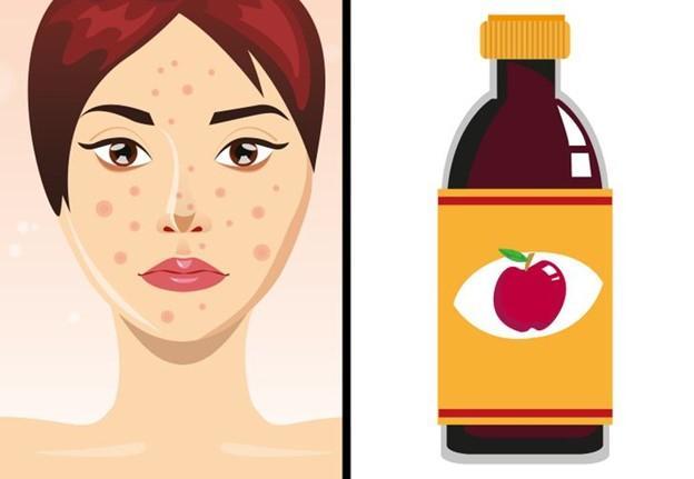 8 Tuyệt chiêu vàng đánh bay sẹo mụn và cải thiện làn da không hoàn hảo