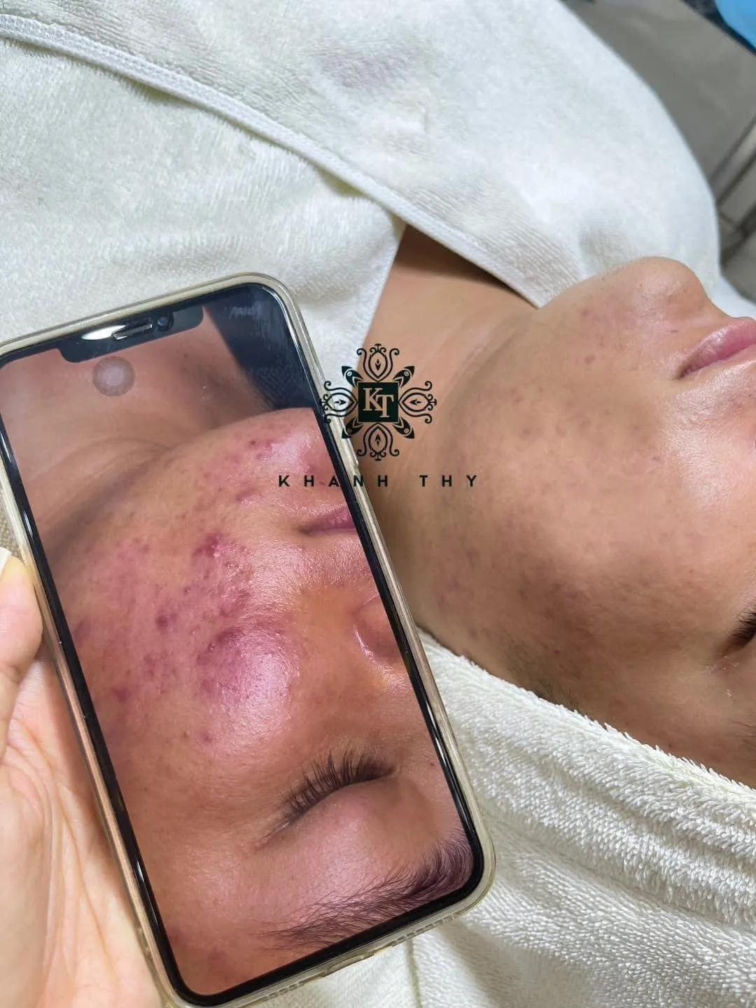 Khám phá 10 địa chỉ trị mụn chất lượng nhất tại Quy Nhơn, Bình Định