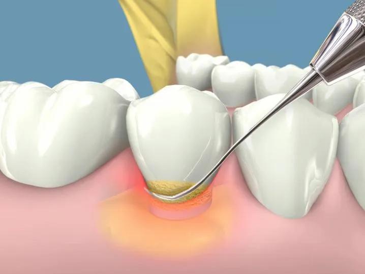 8 Lưu ý Quan Trọng Nhất Về Sưng Nướu Chân Răng