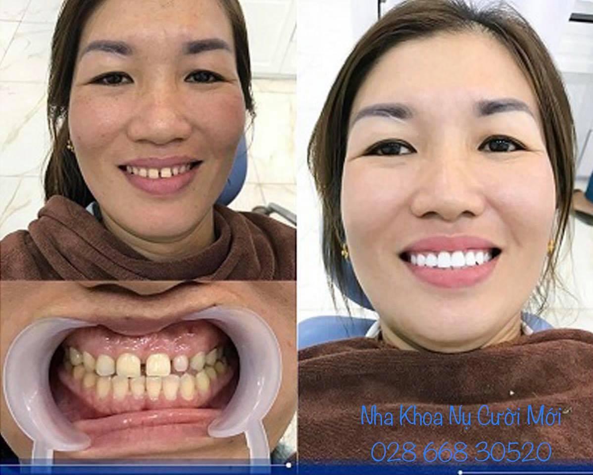 6 Địa chỉ nha khoa chất lượng nhất tại Bến Cát, Bình Dương