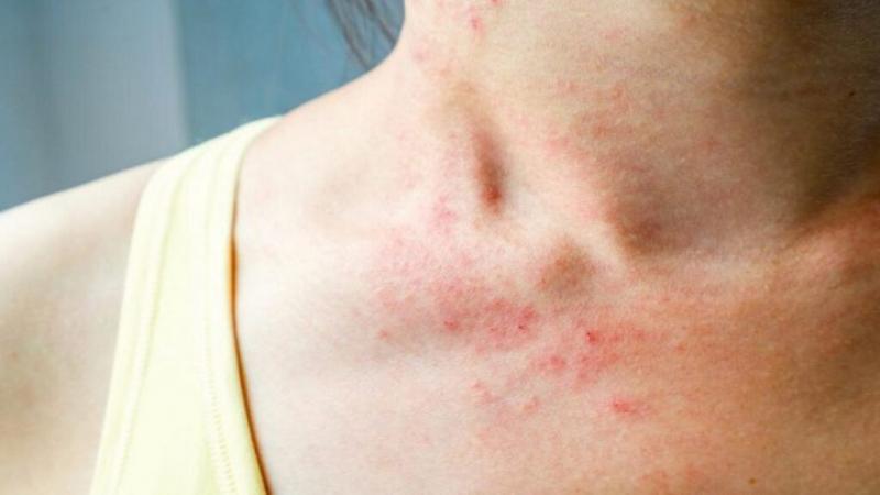 Top 6 Công dụng và lưu ý khi sử dụng Triamcinolone