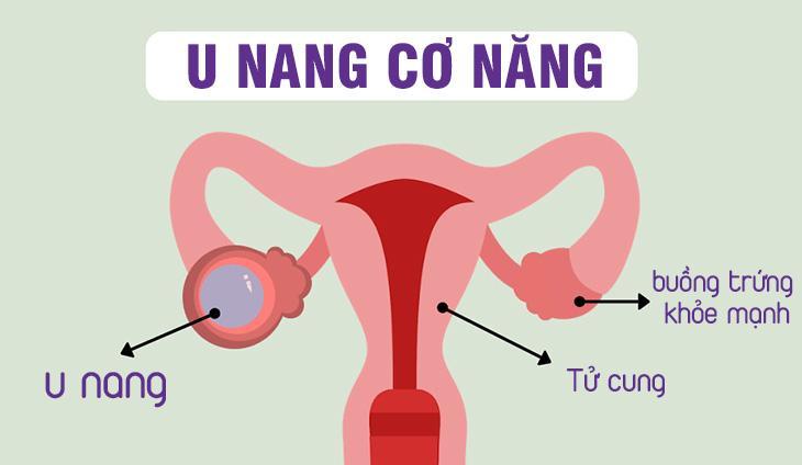 5 Nguyên Nhân Hàng Đầu Và Phương Pháp Điều Trị U Nang Buồng Trứng Hiệu Quả