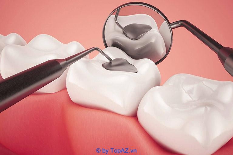 8 địa chỉ trám răng uy tín nhất Hà Nội - Chất lượng đã được kiểm chứng