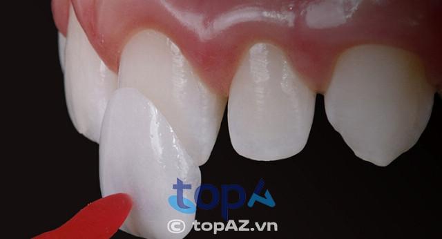 Top 10 địa chỉ dán răng sứ Veneer Hà Nội: Chất lượng đỉnh cao, uy tín vượt trội