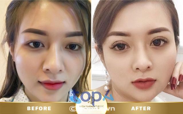 Top 3 địa chỉ cắt mí mắt uy tín tại TP. Mỹ Tho, Tiền Giang với bác sĩ có tay nghề cao