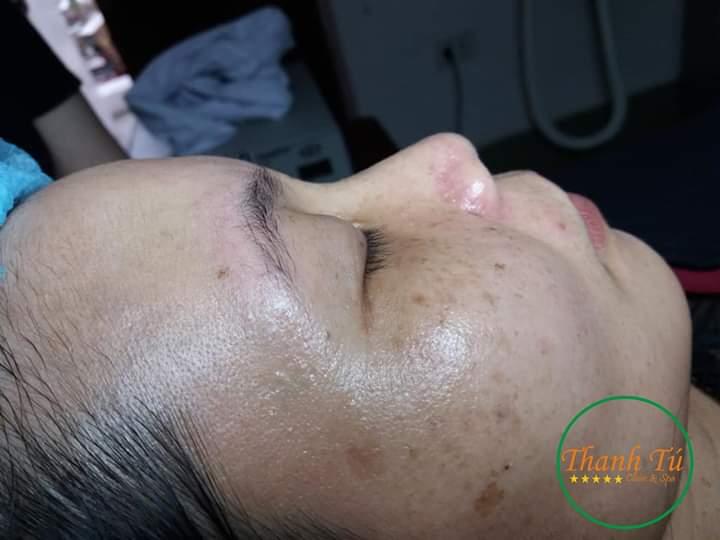 Top 10 Địa Chỉ Điều Trị Nám, Tàn Nhang & Đồi Mồi Uy Tín Nhất Ninh Bình