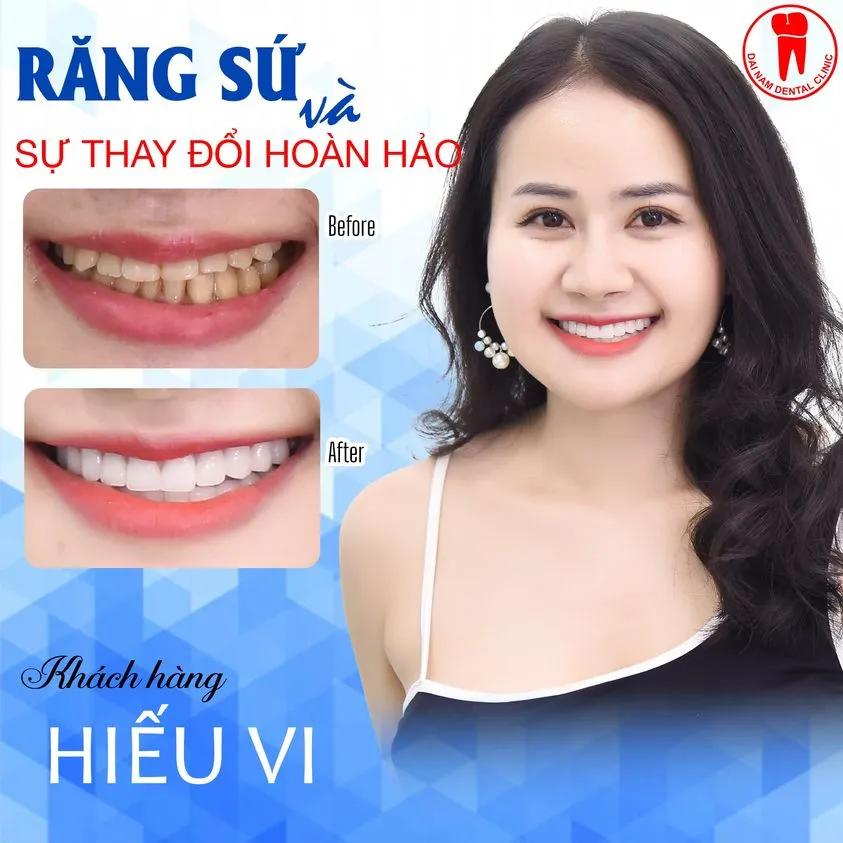 Top 5 địa chỉ bọc răng sứ uy tín và thẩm mỹ hàng đầu tại TP. Pleiku, Gia Lai