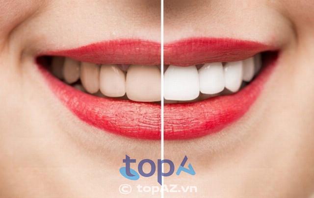 10 địa chỉ tẩy trắng răng Hà Nội đáng trải nghiệm: Chất lượng vượt trội & uy tín hàng đầu