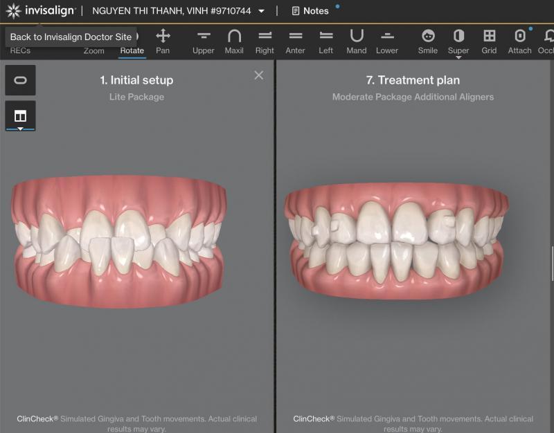 10 Địa Chỉ Niềng Răng Invisalign Đáng Tin Cậy Nhất Hà Nội