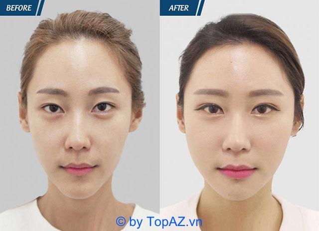 Top 7 địa chỉ cấy mỡ trẻ hóa uy tín và chất lượng tại TPHCM