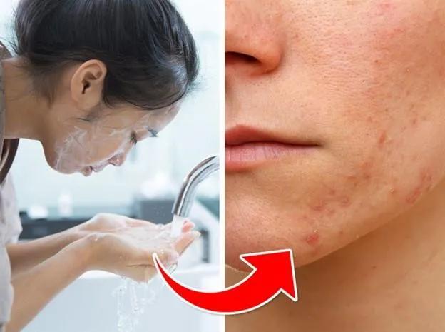 7 Sai Lầm Khi Chăm Sóc Da Có Thể Gây Mụn
