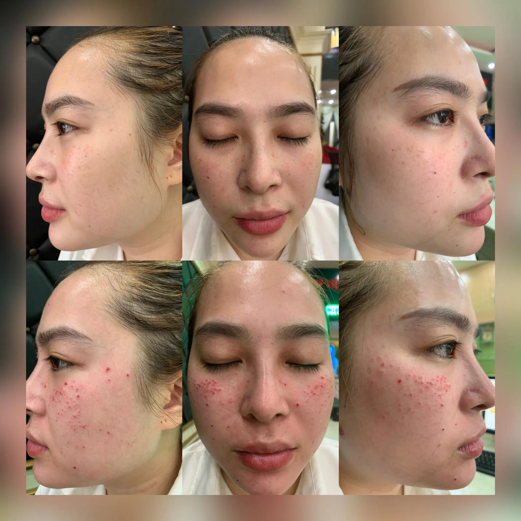 Khám phá top 7 địa chỉ uy tín nhất tại TP. Buôn Ma Thuột chuyên trị nám, tàn nhang và đồi mồi hiệu quả, giúp bạn nhanh chóng lấy lại làn da mịn màng và rạng rỡ.