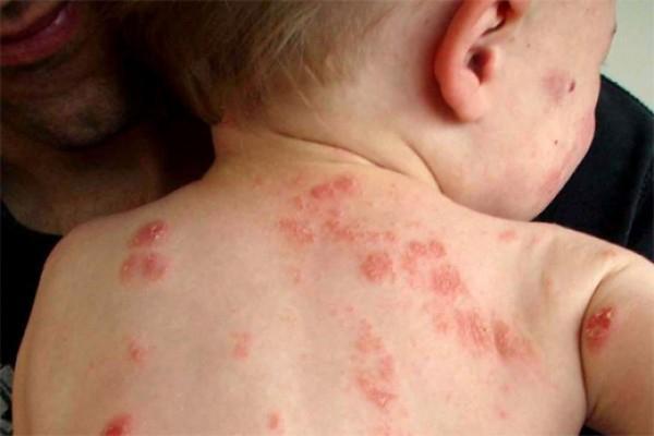 8 Điều Cốt Lõi Cần Nhớ Về Bệnh Zona Thần Kinh
