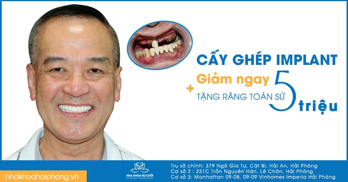 5 Địa điểm trồng răng implant chất lượng hàng đầu tại Hải Phòng