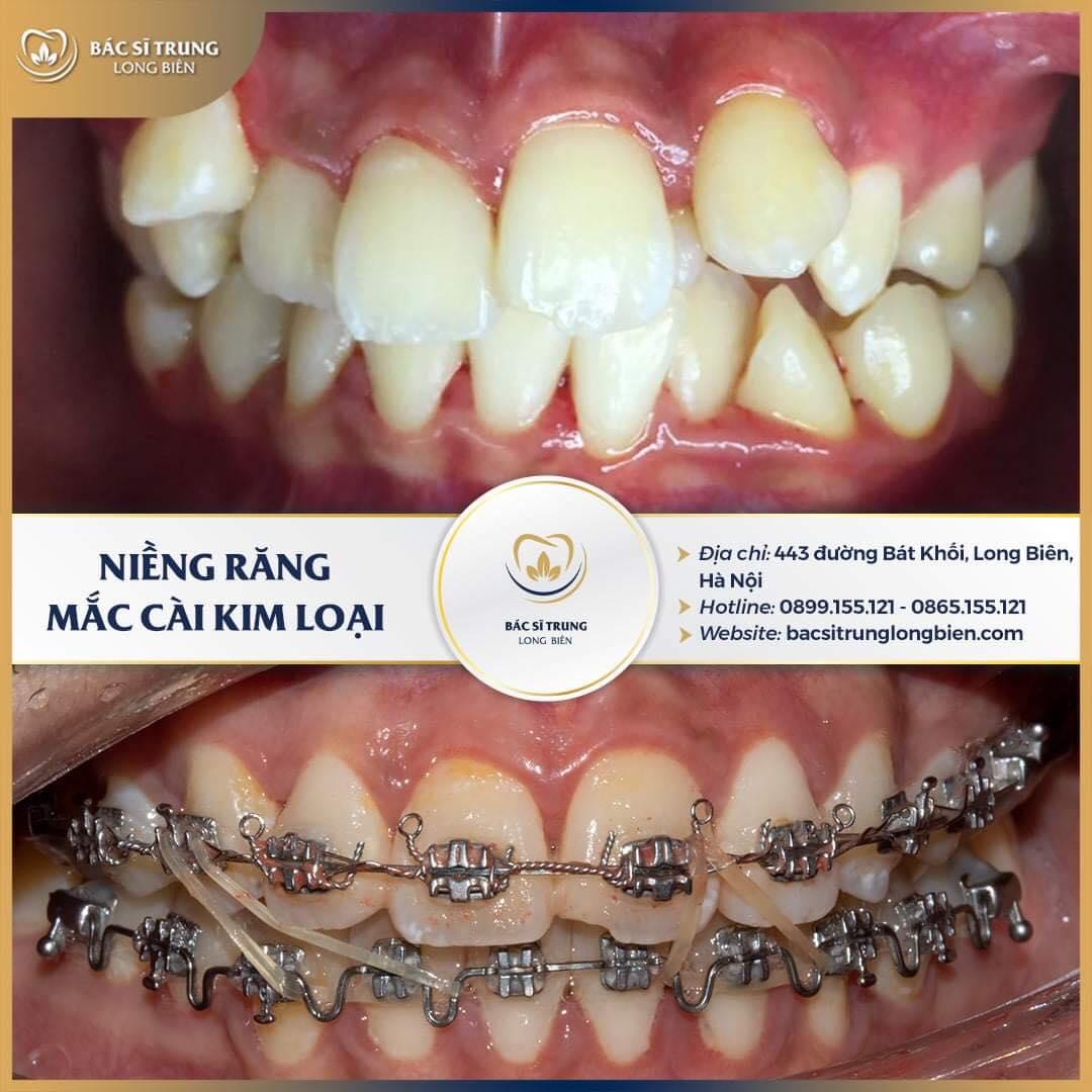 Top 5 Địa chỉ niềng răng uy tín và đẹp nhất tại Gia Lâm, Hà Nội