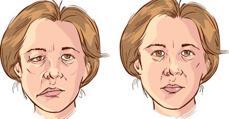 9 Điều cốt lõi cần nhớ về đau dây thần kinh sinh ba (dây V)