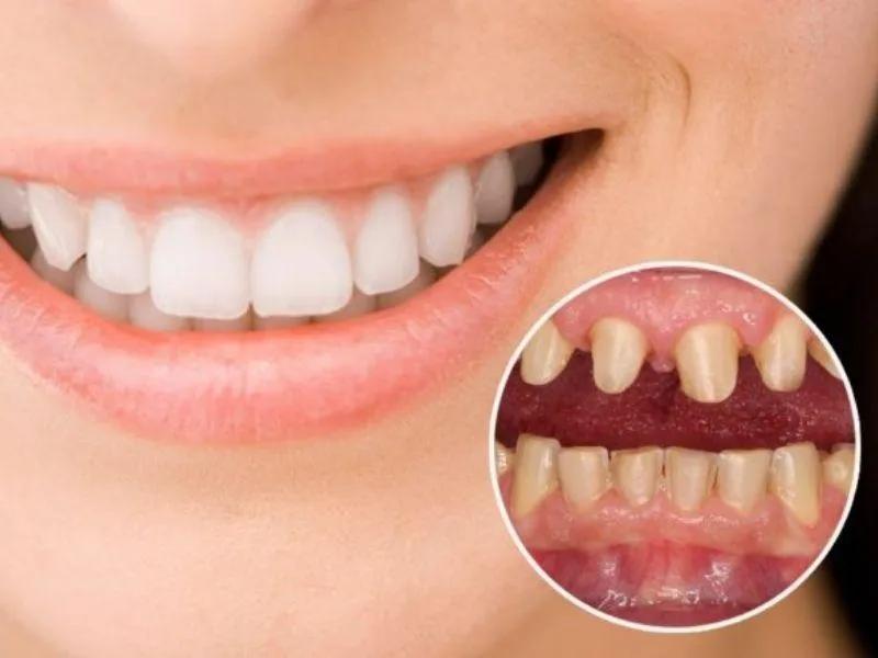 Top 7 điều cần lưu ý khi bọc răng sứ