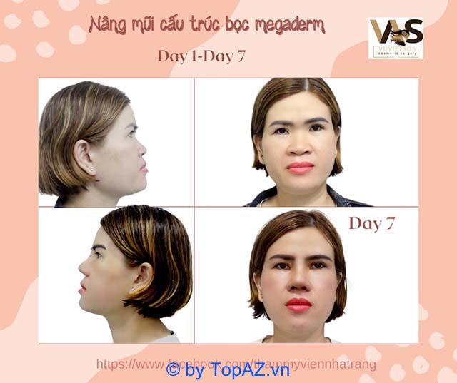 Top 5 địa chỉ nâng mũi uy tín tại TP. Nha Trang, Khánh Hòa không thể bỏ qua