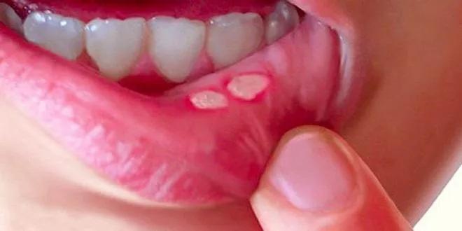 6 Công dụng nổi bật và điểm cần lưu tâm khi dùng Miconazole