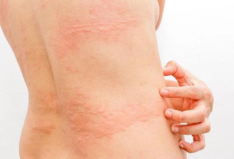 10 Công dụng đáng chú ý và hướng dẫn sử dụng Acetasol HC an toàn