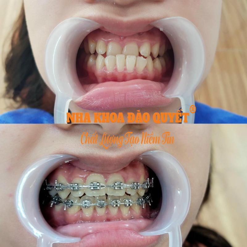 7 Địa Chỉ Nha Khoa Uy Tín Hàng Đầu Tại Thanh Oai, Hà Nội