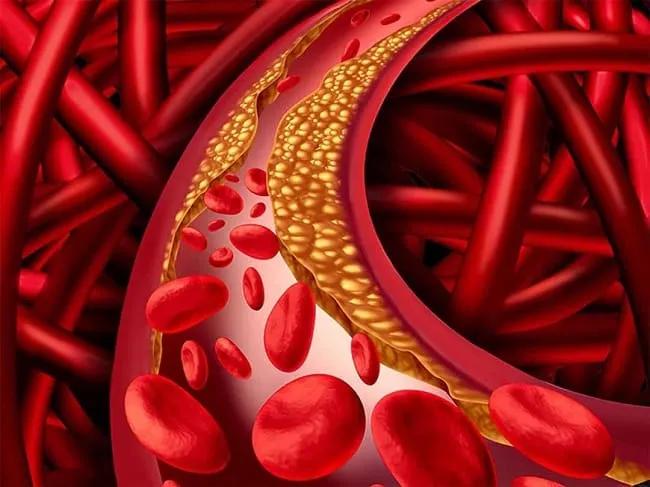 Top 6 thực phẩm chức năng hỗ trợ giảm mỡ máu hàng đầu từ Mỹ