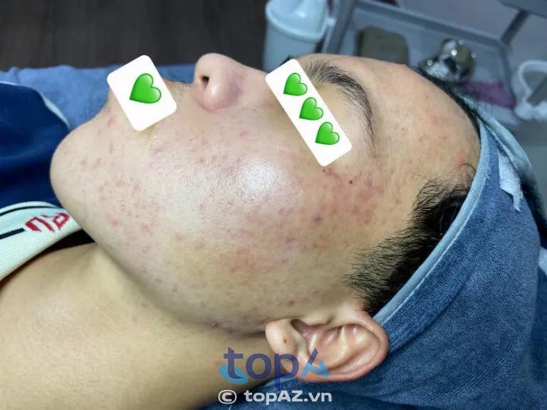 Top 4 địa điểm điều trị sẹo rỗ, lồi, lõm chuẩn y khoa tại Dĩ An