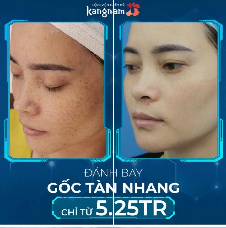 11 Địa chỉ trị nám, tàn nhang, đồi mồi hàng đầu tại Hà Nội